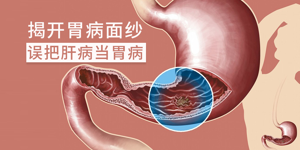 警惕“假胃病”，小心是肝有問題