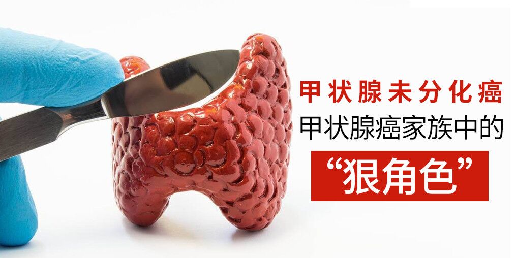 別忽視甲狀腺癌，它的家族也有“狠角色”
